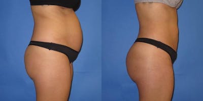 Liposuction Before & After Gallery - Patient 204849 - Image 7
