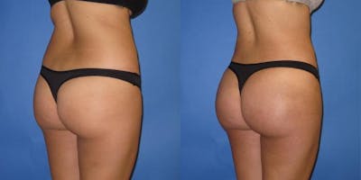 Liposuction Before & After Gallery - Patient 204849 - Image 8