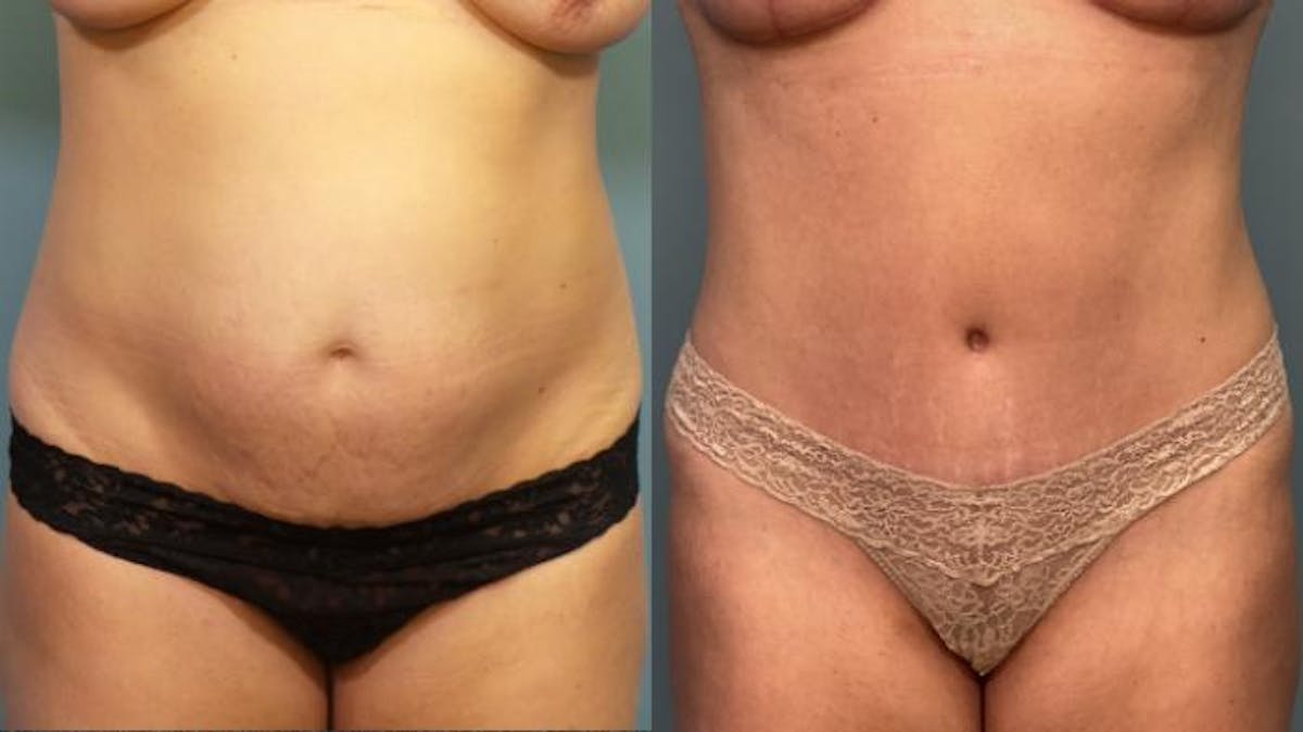 Liposuction Before & After Gallery - Patient 155161 - Image 1