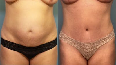 Liposuction Before & After Gallery - Patient 155161 - Image 1