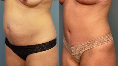 Liposuction Before & After Gallery - Patient 155161 - Image 2
