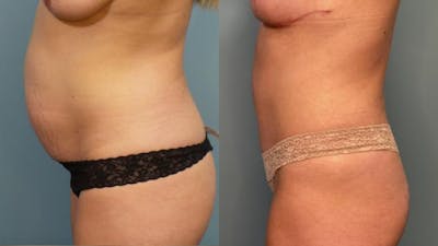 Liposuction Before & After Gallery - Patient 155161 - Image 3