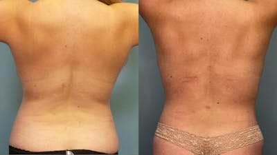 Liposuction Before & After Gallery - Patient 155161 - Image 4
