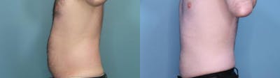 Liposuction Before & After Gallery - Patient 327047 - Image 1