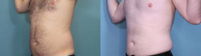Liposuction Before & After Gallery - Patient 327047 - Image 2