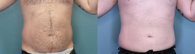 Liposuction Before & After Gallery - Patient 327047 - Image 3