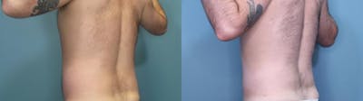 Liposuction Before & After Gallery - Patient 327047 - Image 4
