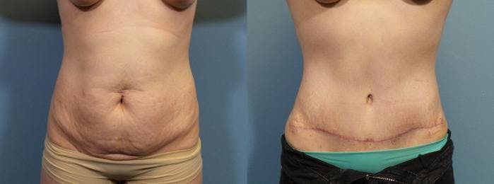 Liposuction Before & After Gallery - Patient 132846 - Image 1