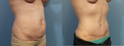 Liposuction Before & After Gallery - Patient 132846 - Image 2