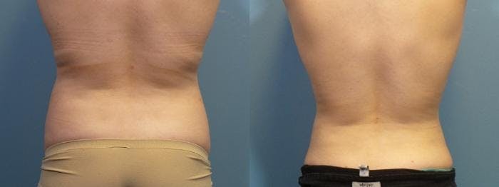 Liposuction Before & After Gallery - Patient 132846 - Image 3