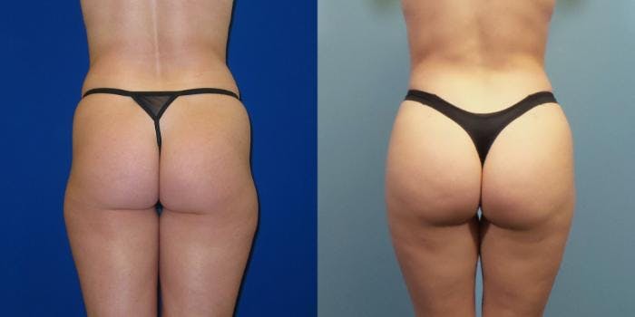 Liposuction Before & After Gallery - Patient 167980 - Image 1
