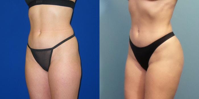 Liposuction Before & After Gallery - Patient 167980 - Image 2