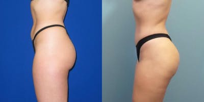 Liposuction Before & After Gallery - Patient 167980 - Image 3