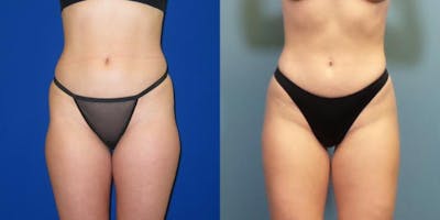 Liposuction Before & After Gallery - Patient 167980 - Image 4
