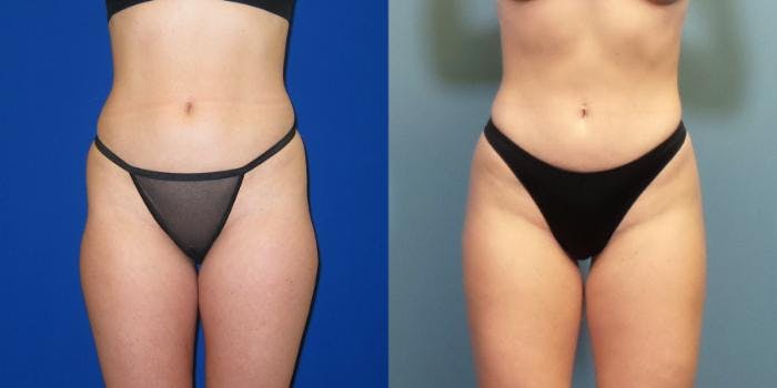 Liposuction Before & After Gallery - Patient 167980 - Image 4