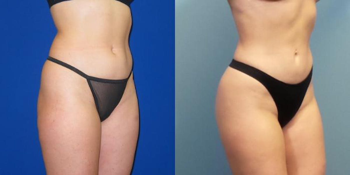 Liposuction Before & After Gallery - Patient 167980 - Image 5