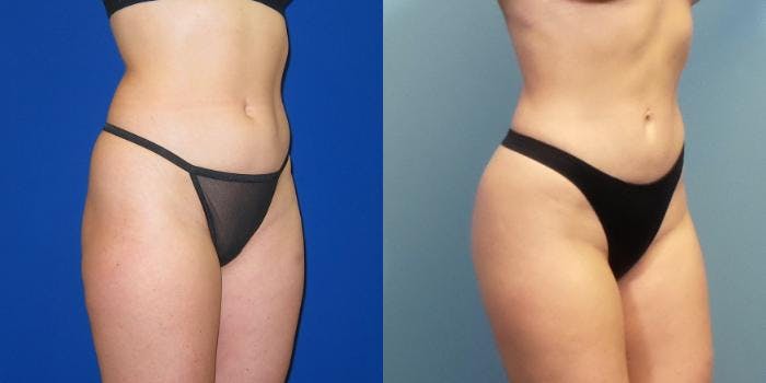 Liposuction Before & After Gallery - Patient 167980 - Image 5