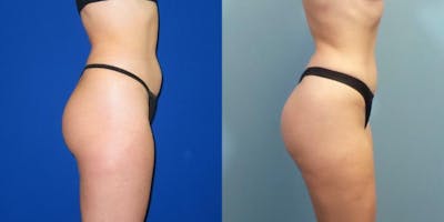 Liposuction Before & After Gallery - Patient 167980 - Image 6