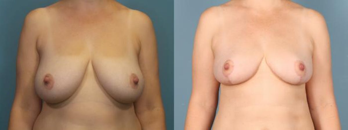 Liposuction Before & After Gallery - Patient 248969 - Image 1