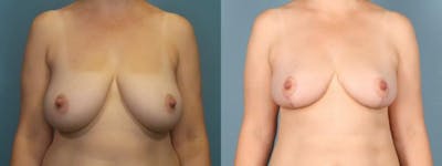 Liposuction Before & After Gallery - Patient 248969 - Image 1