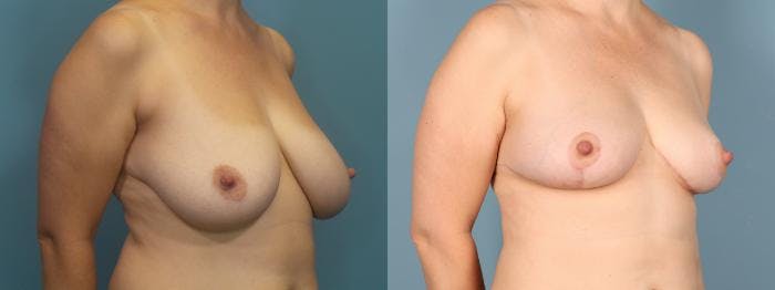 Liposuction Before & After Gallery - Patient 248969 - Image 2