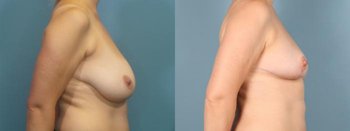 Liposuction Before & After Gallery - Patient 248969 - Image 3