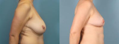 Liposuction Before & After Gallery - Patient 248969 - Image 3