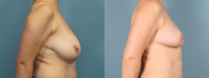 Liposuction Before & After Gallery - Patient 248969 - Image 3