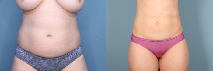 Liposuction Before & After Gallery - Patient 248969 - Image 4