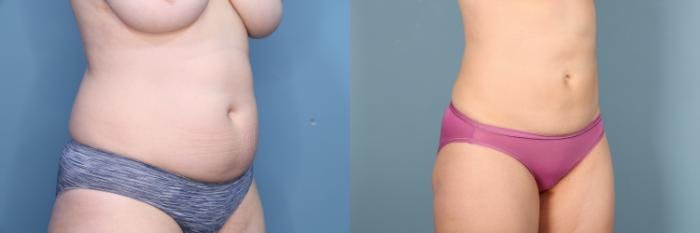 Liposuction Before & After Gallery - Patient 248969 - Image 5