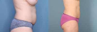Liposuction Before & After Gallery - Patient 248969 - Image 6