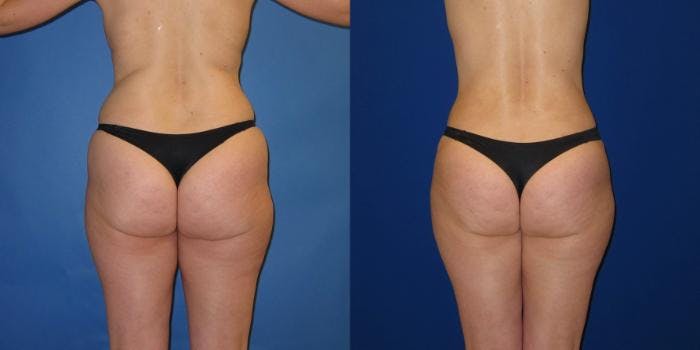 Liposuction Before & After Gallery - Patient 159989 - Image 1