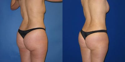 Liposuction Before & After Gallery - Patient 159989 - Image 2