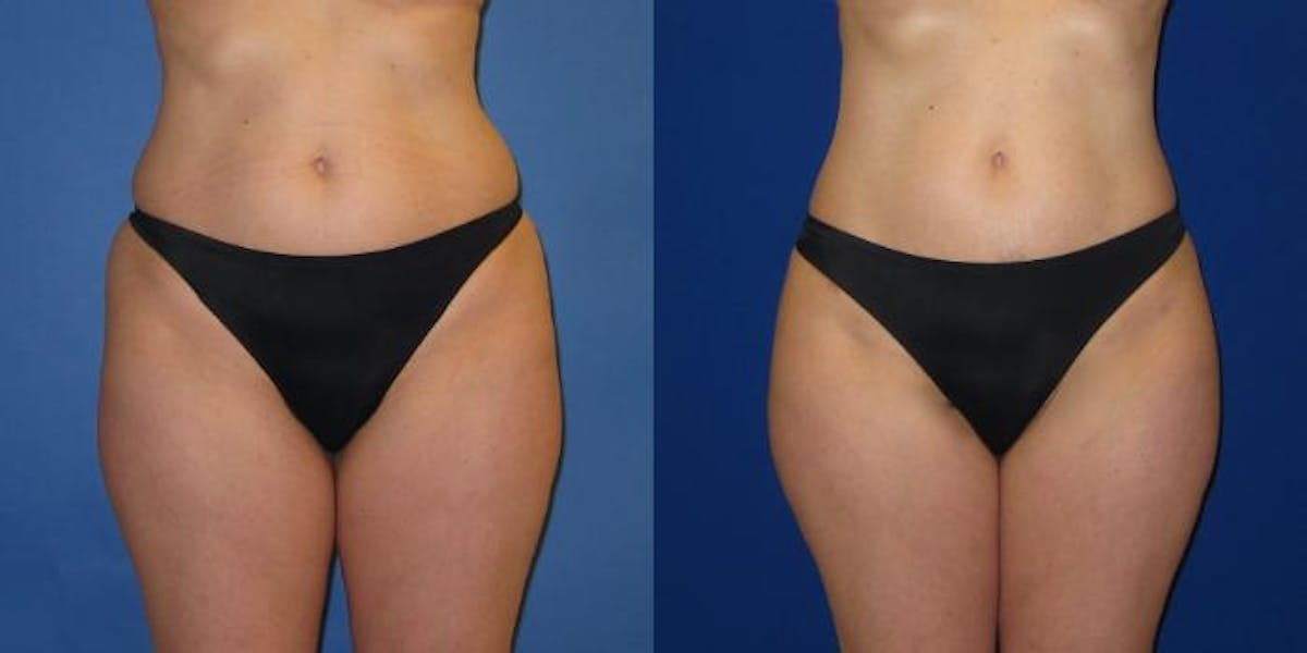 Liposuction Before & After Gallery - Patient 159989 - Image 3