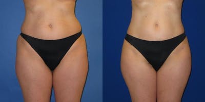 Liposuction Before & After Gallery - Patient 159989 - Image 3