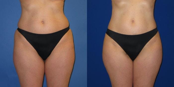 Liposuction Before & After Gallery - Patient 159989 - Image 3