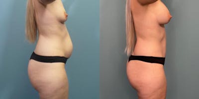 Mommy Makeover Before & After Gallery - Patient 288045 - Image 1