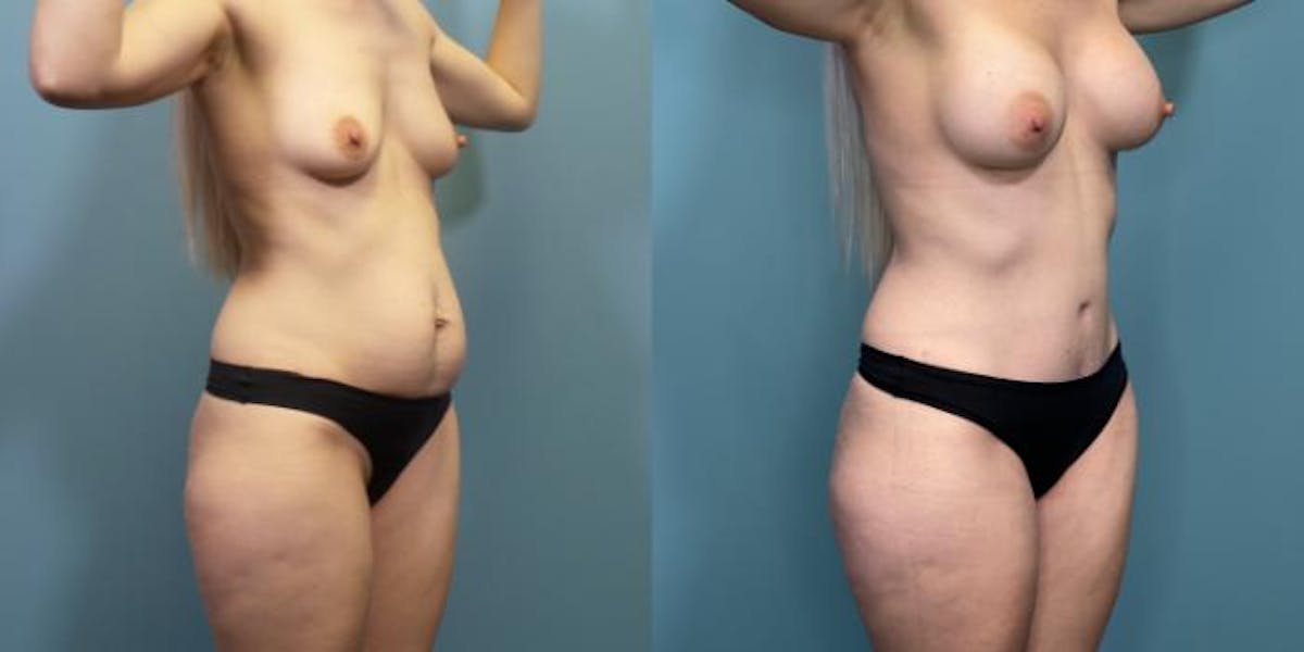 Mommy Makeover Before & After Gallery - Patient 288045 - Image 2