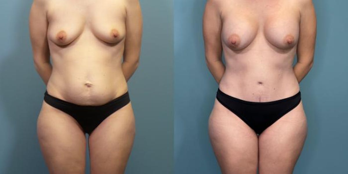Mommy Makeover Before & After Gallery - Patient 288045 - Image 3