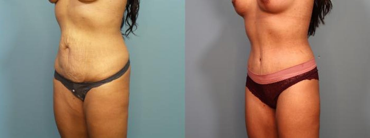Mommy Makeover Before & After Gallery - Patient 194715 - Image 4