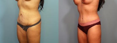 Mommy Makeover Before & After Gallery - Patient 194715 - Image 4