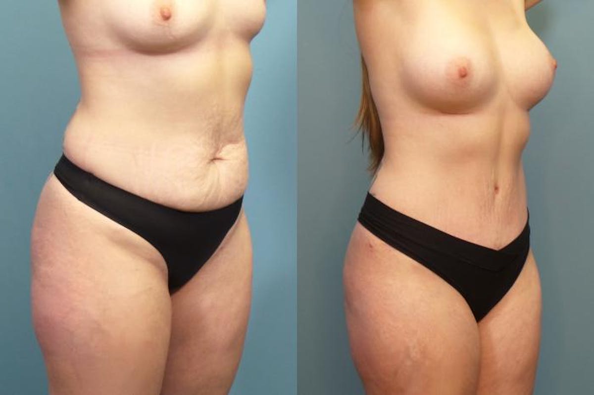 Mommy Makeover Before & After Gallery - Patient 221016 - Image 1