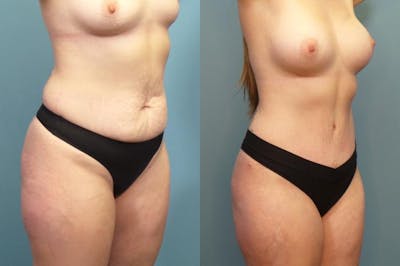 Mommy Makeover Before & After Gallery - Patient 221016 - Image 1