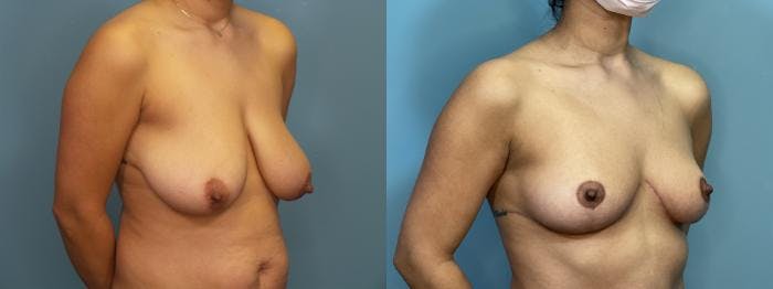 Mommy Makeover Before & After Gallery - Patient 204911 - Image 3