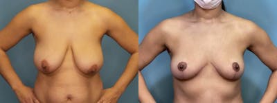 Mommy Makeover Before & After Gallery - Patient 204911 - Image 4