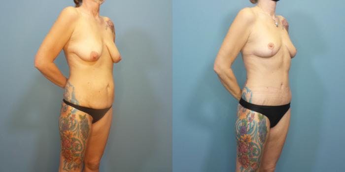 Mommy Makeover Before & After Gallery - Patient 185544 - Image 2