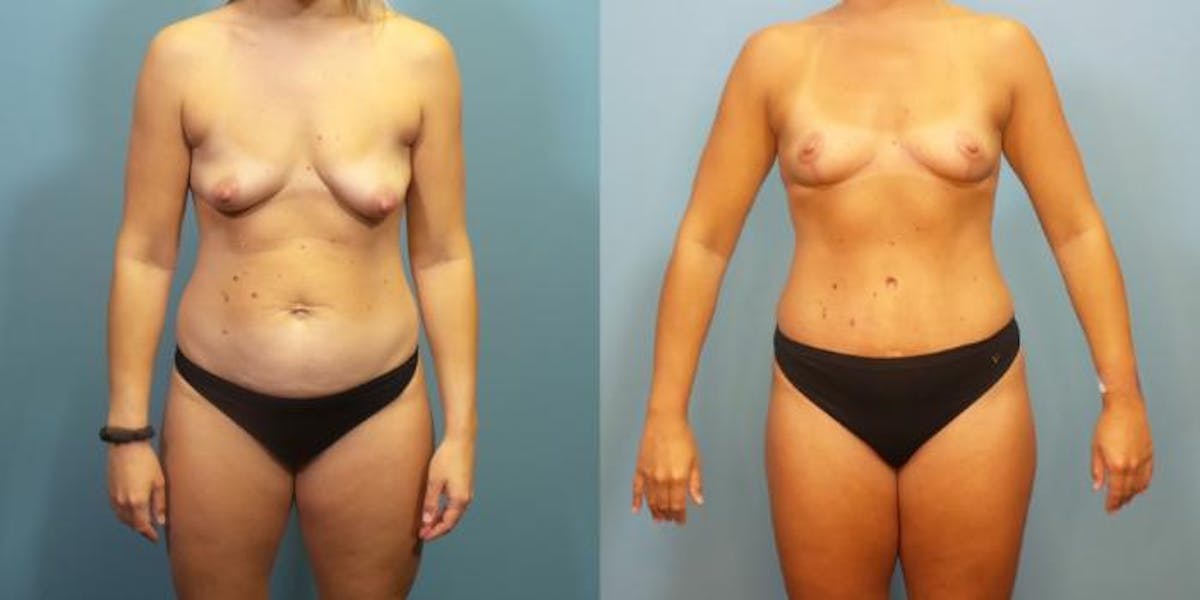 Mommy Makeover Before & After Gallery - Patient 211464 - Image 1