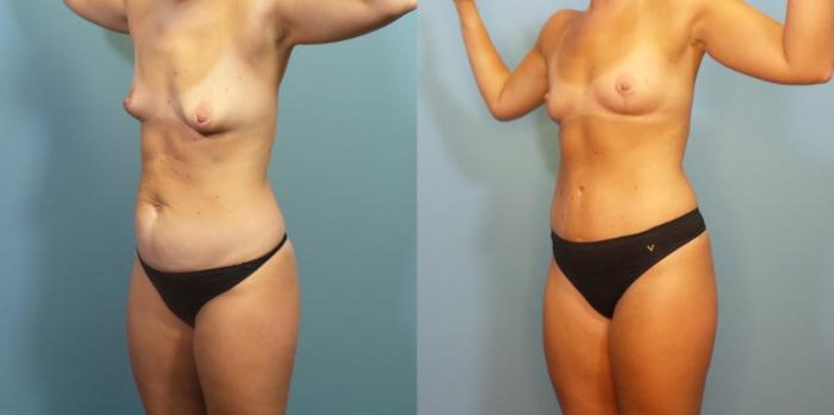 Mommy Makeover Before & After Gallery - Patient 211464 - Image 2