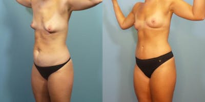 Mommy Makeover Before & After Gallery - Patient 211464 - Image 2