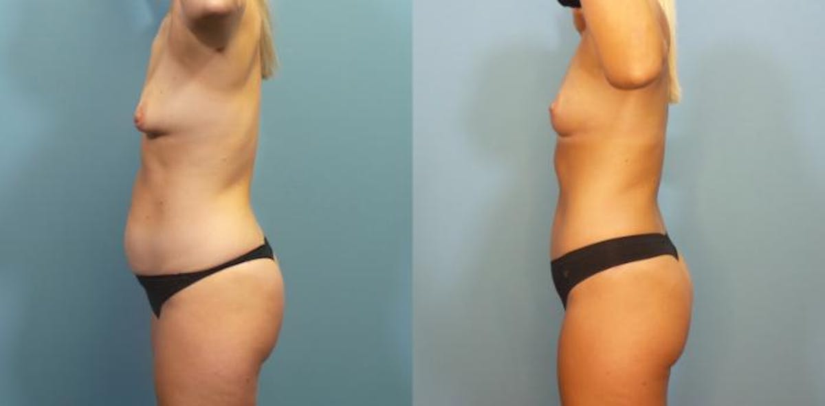 Mommy Makeover Before & After Gallery - Patient 211464 - Image 3